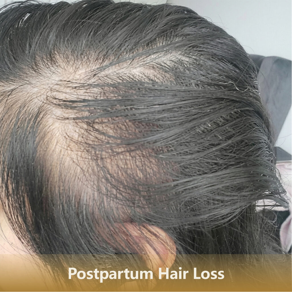 Home 3 产后Postpartum Hair Loss 1 1024x1024