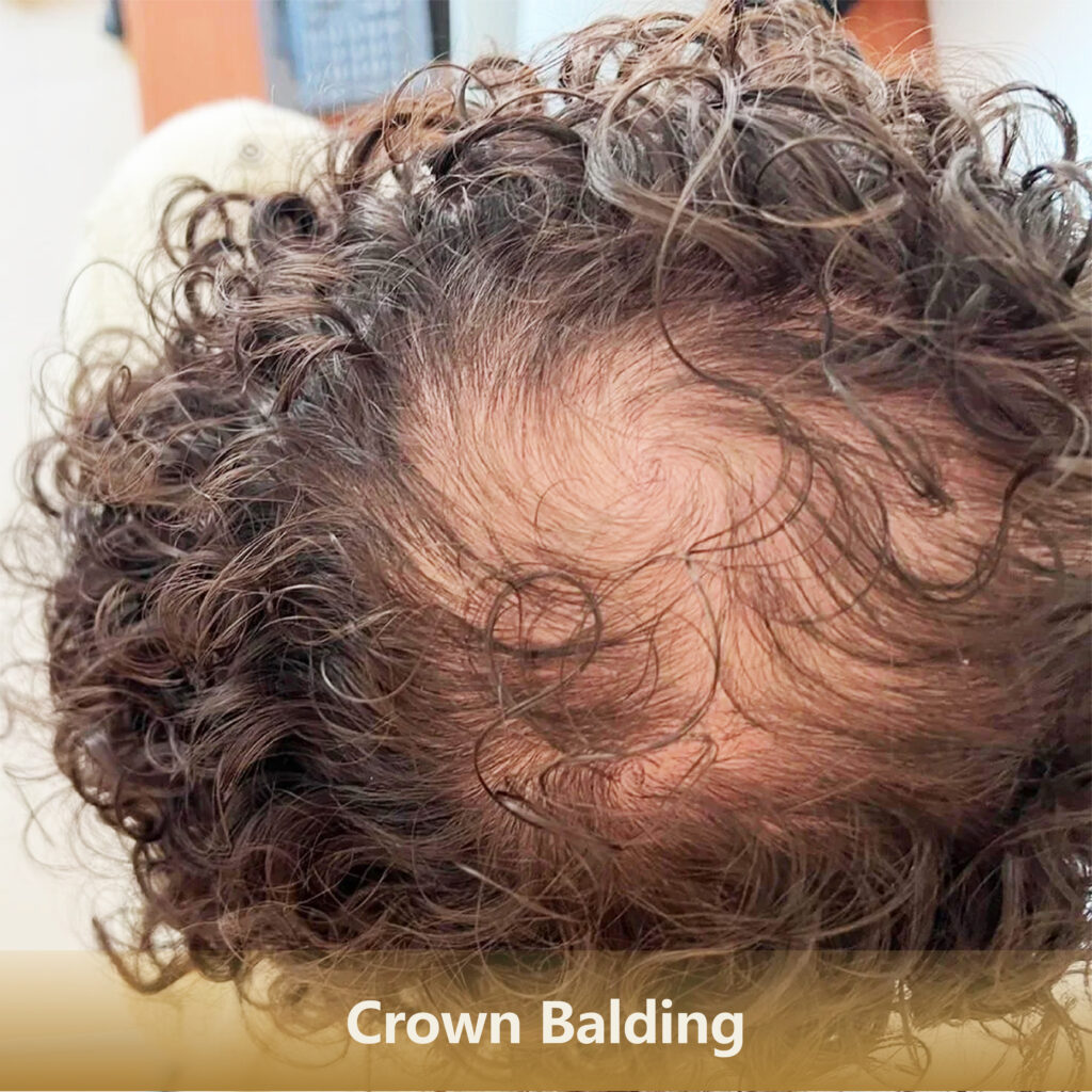 Home 4 地中海Crown Balding 1 1024x1024
