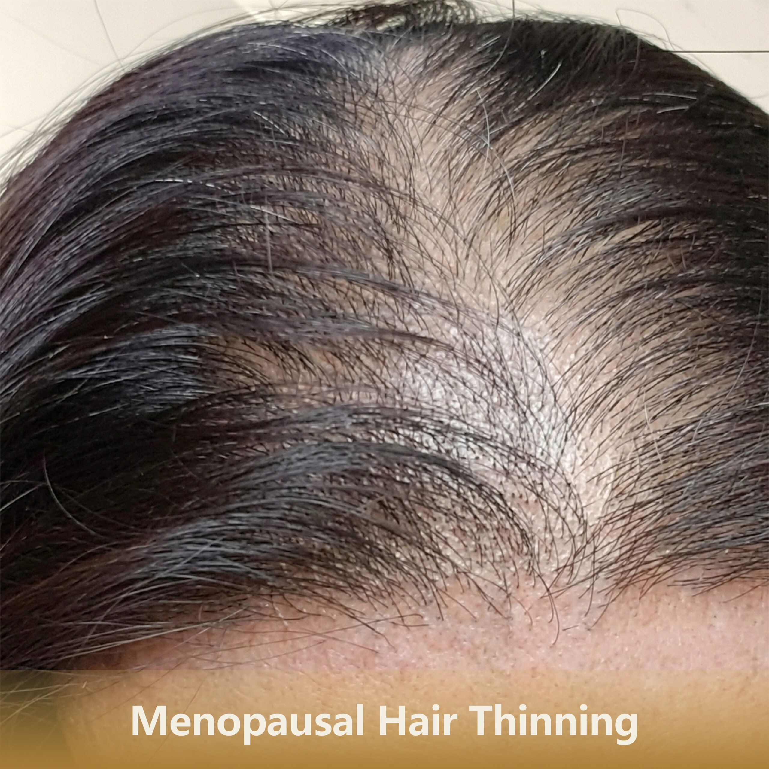 Home 5 更年期脱发Menopausal Hair Thinning 1 Scaled