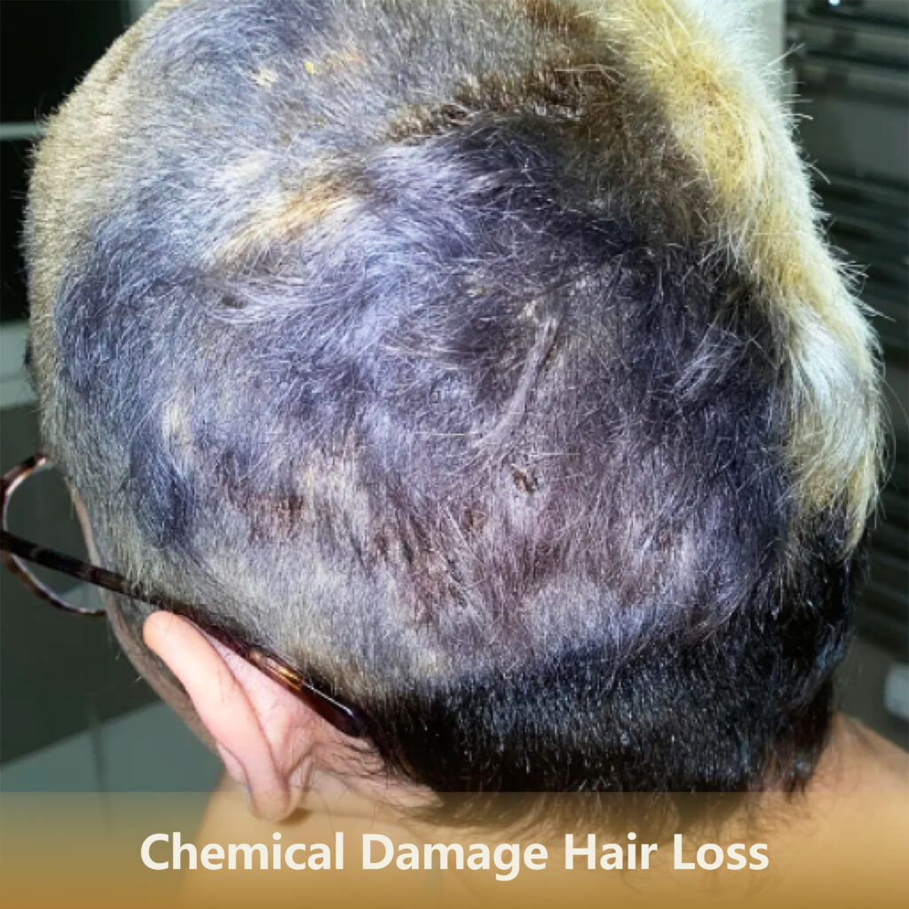 Home 6 化学脱发Chemical Damage Hair Loss 1 1024x1024