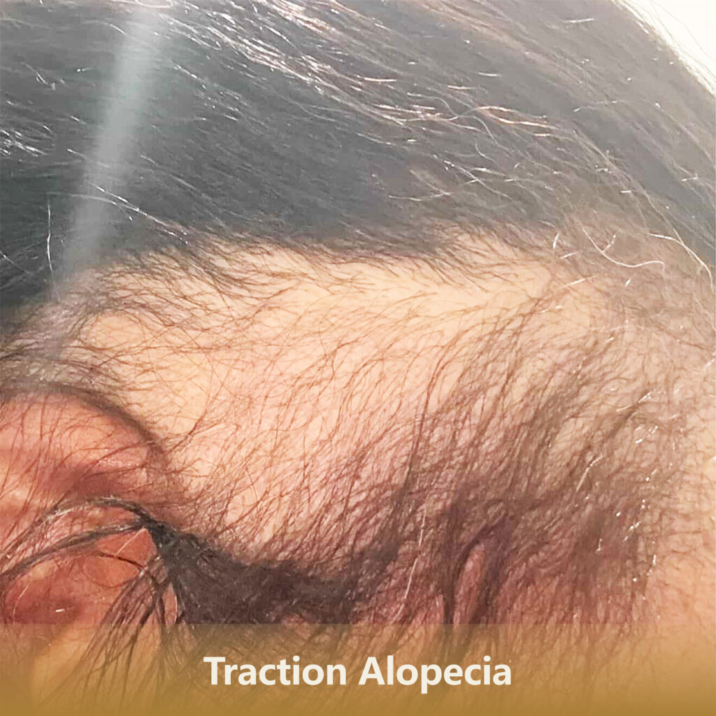 Home 7 牵引性Traction Alopecia 1 1024x1024