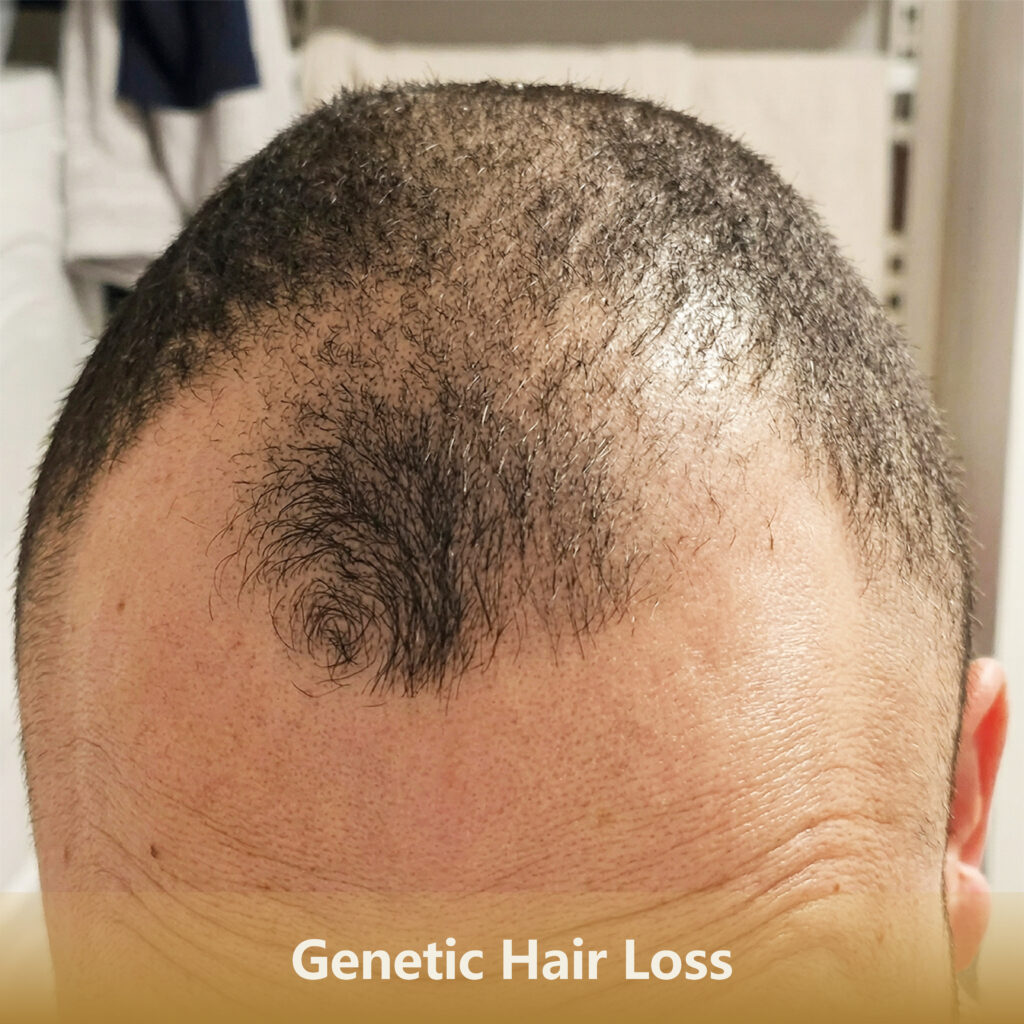 Home 9 遗传Genetic Hair Loss 1 1024x1024